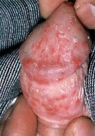 Entladung vum Penis wéinst Thrush
