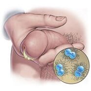 gonorrhea Entladung